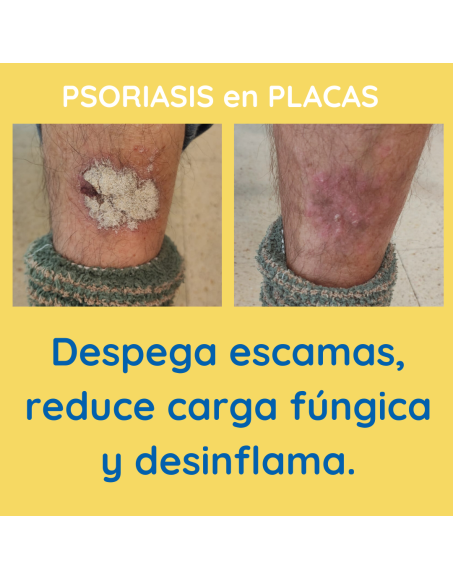 Psoriasis en placas champú contra la Caspa