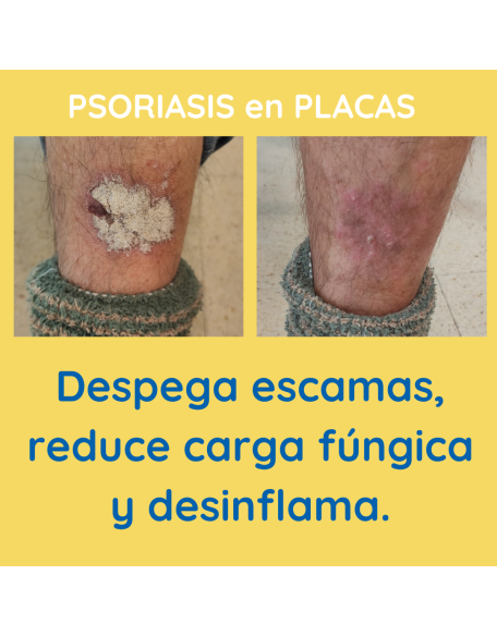 Psoriasis en placas champú contra la Caspa