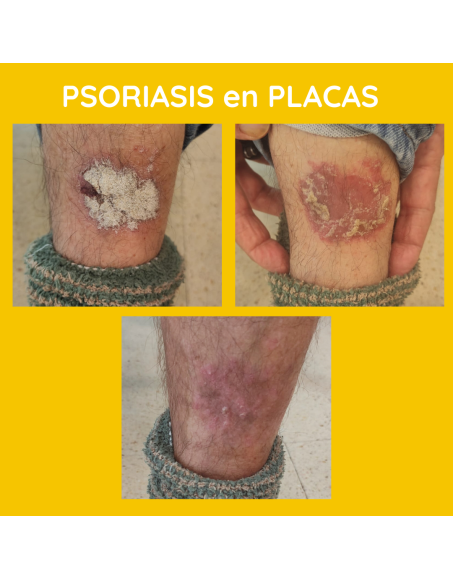 Psoriasis en placas champú contra la Caspa