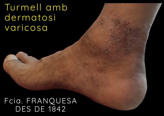 Turmell afectat de dermatosi varicosa, es pot observar coloració ocre i inici de lesió preúlcerosa