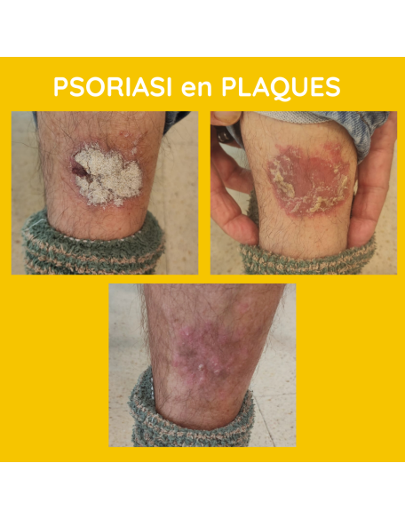 Psoriasi en plaques xampú contra la Caspa 1842