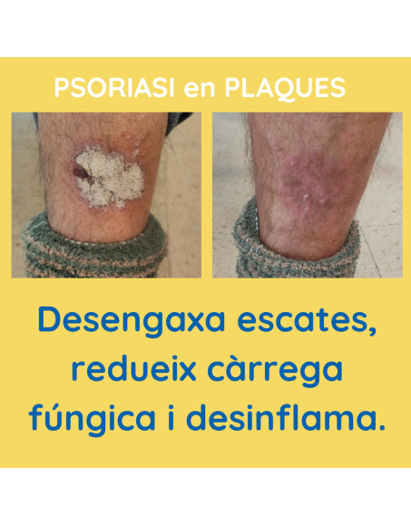 Psoriasi en plaques xampú contra la Caspa 1842