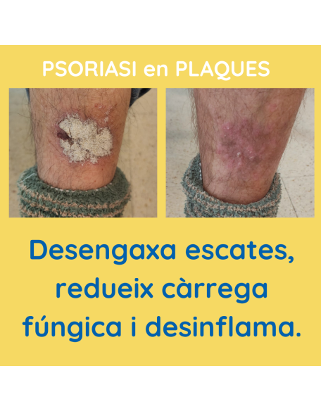 Psoriasi en plaques xampú contra la Caspa 1842